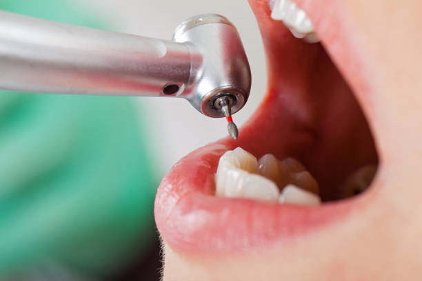 Best Emergency Root Canal Treatment in Moses Lake North, WA